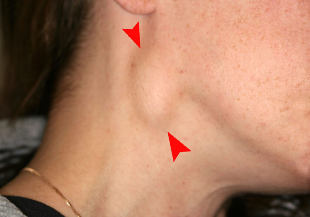 lamotrigine and swollen supraclavicular lymph nodes