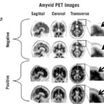 رادیوداروی 18F-florbetapir برای تشخیص بیماری آلزایمر