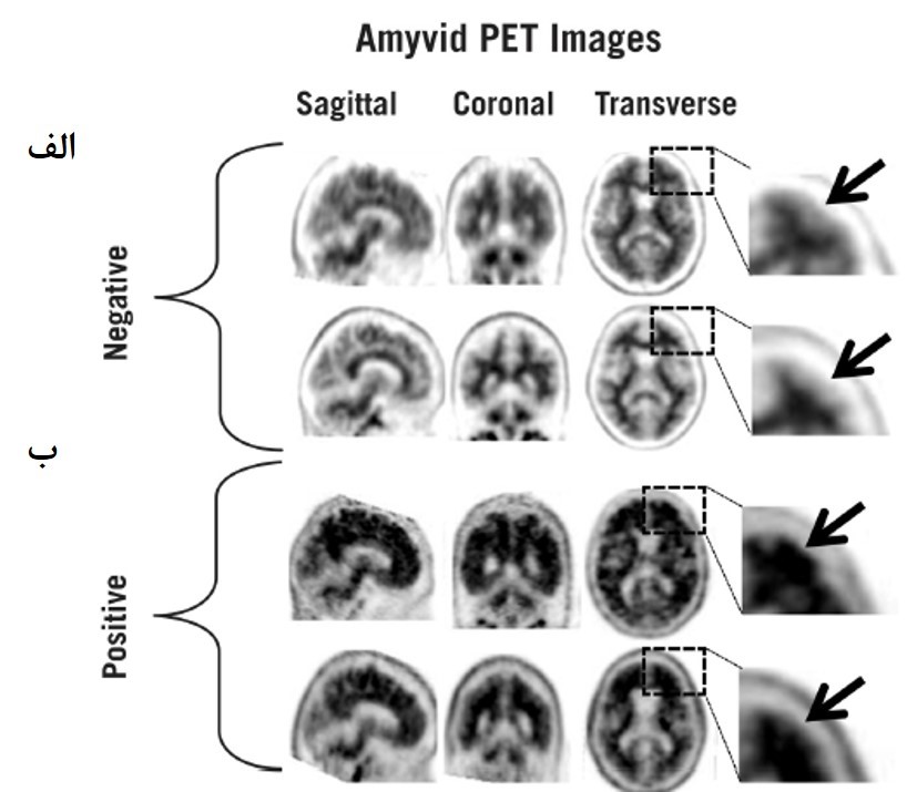 رادیوداروی 18F-florbetapir برای تشخیص بیماری آلزایمر با استفاده از PET/CT