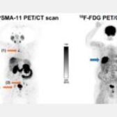 رادیوداروهای 68Ga-PSMA و 18F-PSMA برای تصویربرداری از سرطان پروستات