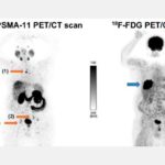 رادیوداروهای 68Ga-PSMA و 18F-PSMA برای تصویربرداری از سرطان پروستات
